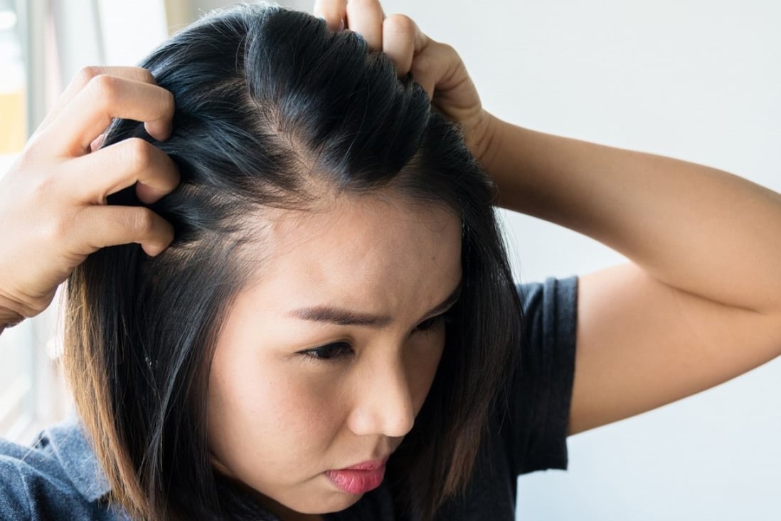 Hair loss: its causes, how to head it off and where to look for help when you can't stop thinning hair | South China Morning Post Hair loss: its causes, how to head it off and where to look for help when you can't stop thinning hair | South China Morning Post