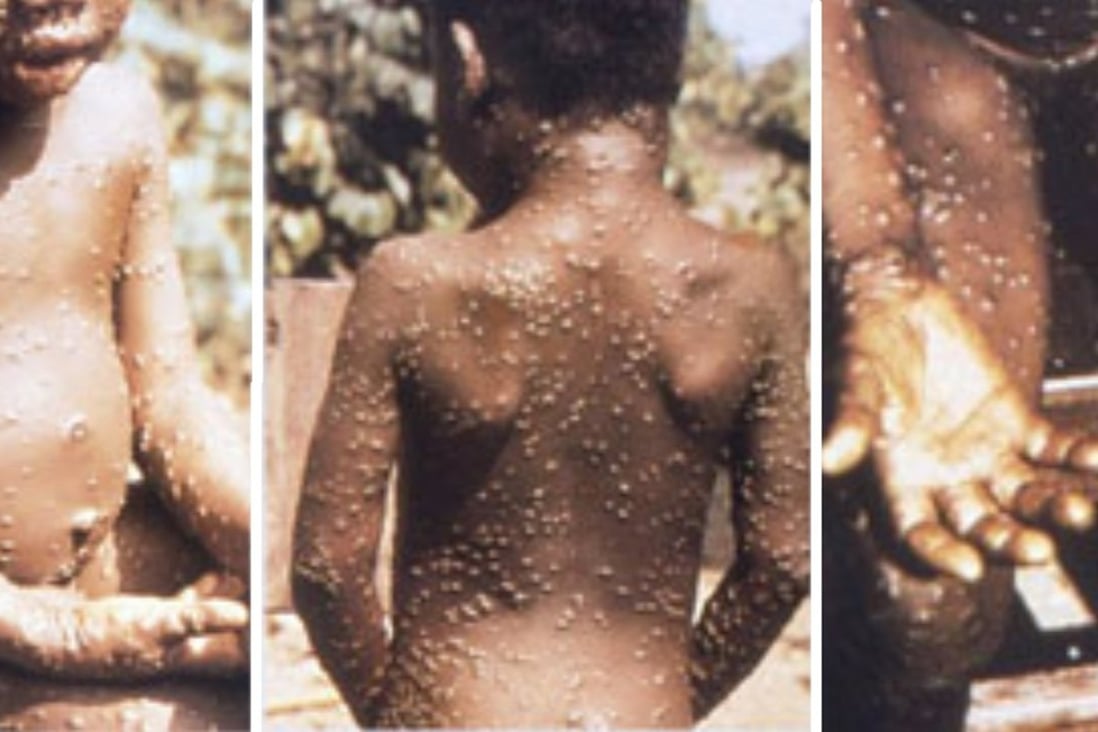Young victims of the monkeypox virus in Africa. Photos: CDC