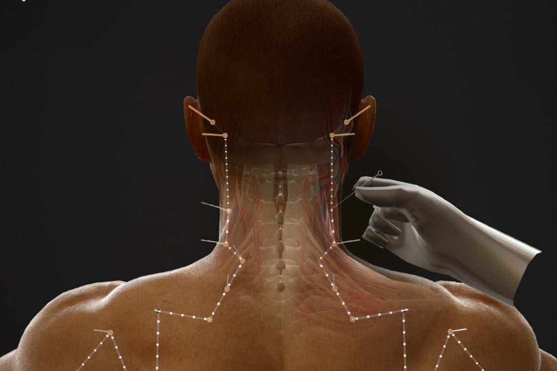 The BodyMap system is described as a Google Map for the human body that acupuncture could benefit from. Photo: BodyMap