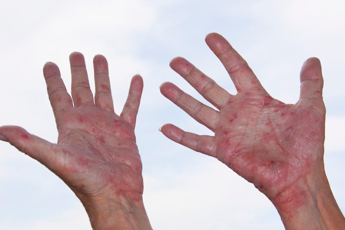 Eczema: its causes, how to get relief from the itching, and the promise ...