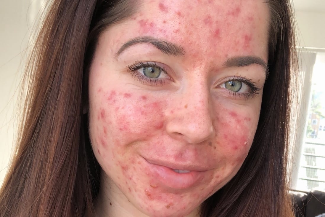 maandelijks Seizoen effect Acne: why some adults have it, how to treat it, and one Instagrammer's  battle with chronic acne | South China Morning Post