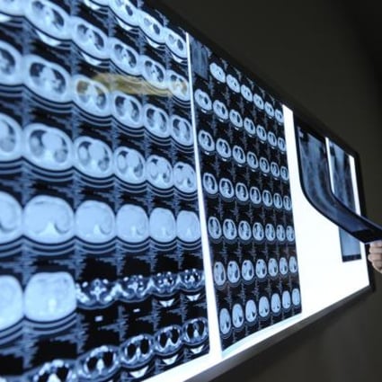 A doctor looks at lung CT images and chest films of a man infected with H7N9. The new bird flu could be mutating up to eight times faster than an average flu virus. Photo: Xinhua