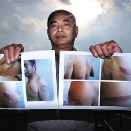 Wang presents photos showing long streaks of burn marks and scars on his body.  