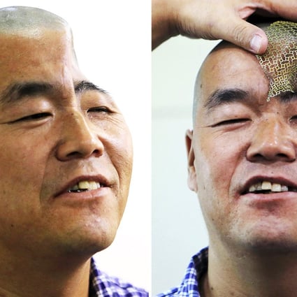 The man, surnamed Hu, lost part of his head in an accident but will now be surgically fitted with a new skull. Photos: Reuters