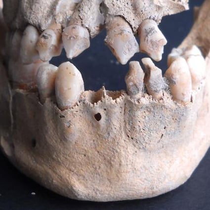 Teeth from the remains of African slaves show evidence of cultural modification. A new study traced the DNA from three sets of remains to their region of origin in Africa. Photo: Hannes Schroeder / Natural History Museum of Denmark