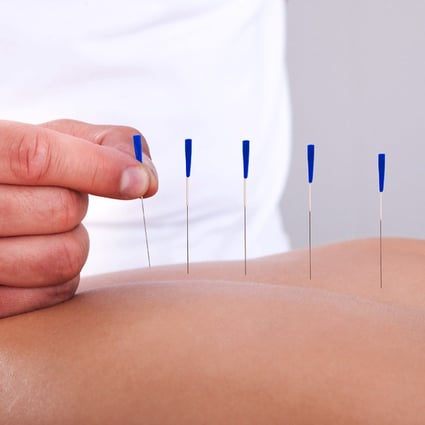 Probe after Hong Kong woman, 29, dies following acupuncture at Causeway