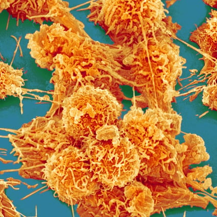 Immunotherapy is being hailed as the new hope to tame cancer at the American Society of Clinical Oncology meeting in Chicago. Photo: Corbis