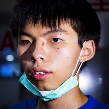 Student leader Joshua Wong shows his injuries after receiving treatment at Kwong Wah Hospital. A man attacked him in Tai Kok Tsui shortly after midnight. Photo: Reuters