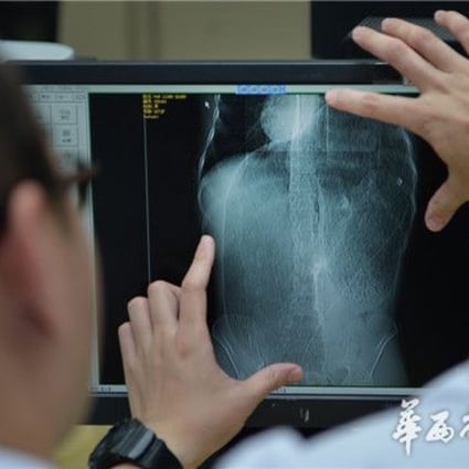 Doctors at Chengdu's No 2 Hospital view an X-ray of the patient's colon. Photo: 163.com