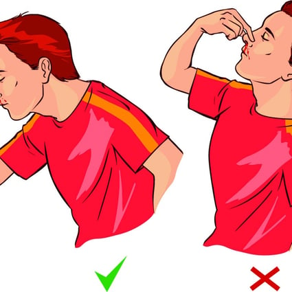 The right and wrong way to stem a nosebleed. Illustration: Corbis