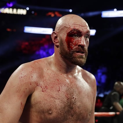Tyson Fury of England gets a cut over his right eye in a heavyweight boxing tune-up match against Otto Wallin of Sweden in Las Vegas in 2019, Photo: AP  