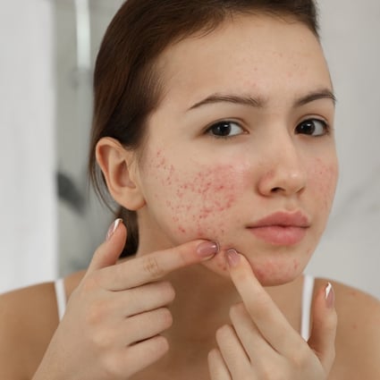 Skin Problem Solving Acne Treatment And Cleansing Pore For Perfect Womans  Face Vector Icons Stock Illustration - Download Image Now - iStock
