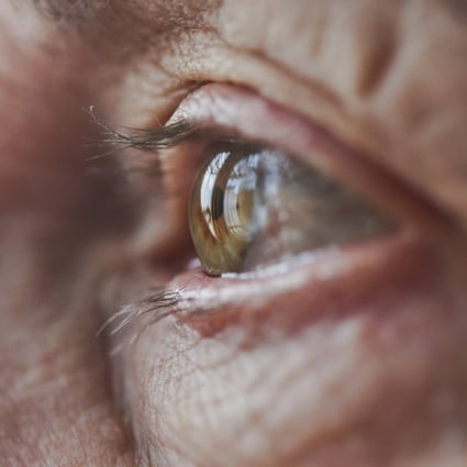 The University of California, San Francisco team examined tiny blood vessels at the back of the eyes of elderly people with and without APOE4 gene mutations, the most prevalent genetic risk for Alzheimer’s disease. Photo: Getty Images