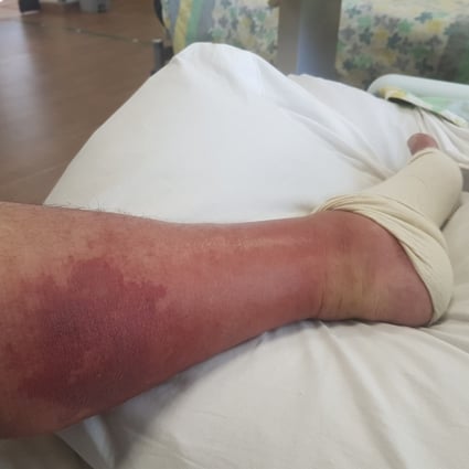 My Cellulitis Scare How A Serious Bacterial Infection Was Sparked By One Wrong Step On A Hong Kong Beach South China Morning Post