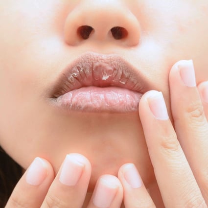 Dry, chapped lips are both uncomfortable and visually displeasing, and make you more vulnerable to painful and unsightly blisters. Photo: Shutterstock