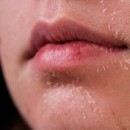 Although dry skin and dehydrated skin can feel very similar, there is a huge difference between the two. Photo: Shutterstock