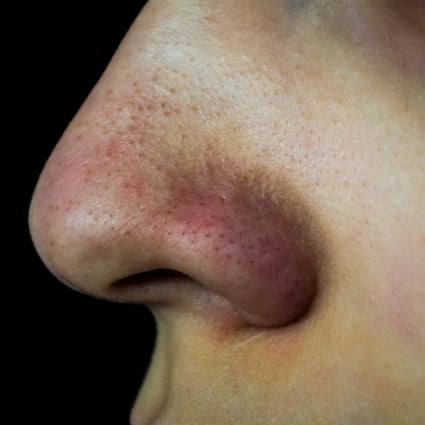 Blackheads are seemingly impossible to get rid of, and they always seem to crop up on the nose. Photo: Shutterstock