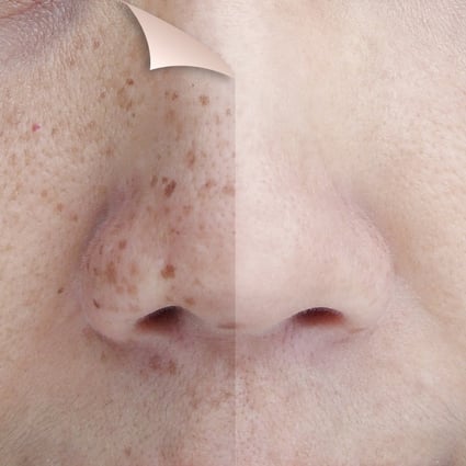 Dark spots, or hyperpigmentation, can be caused by a number of things, from ageing to sun exposure. Photo: Shutterstock