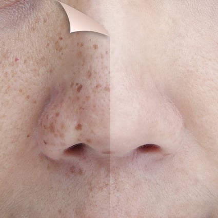 What Causes Hyperpigmentation Dark Spots On Your Face And How To Get Rid Of Them South China Morning Post What Causes Hyperpigmentation Dark Spots On Your Face And How To Get Rid Of Them South China Morning Post