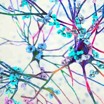 An illustration of antibodies attacking a neuron. Most doctors have little knowledge of how to diagnose and treat rare diseases. Advances in science are helping to change this. Photo: Shutterstock