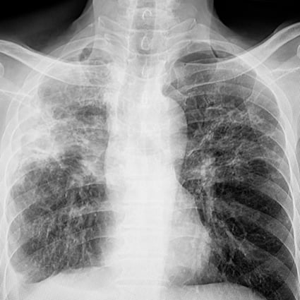 For countries with a high burden of latent TB infection, such as China, having a vaccine to prevent the onset of disease would be crucial. The World Health Organization says the Covid-19 pandemic has disrupted TB notifications. Photo: Shutterstock Images
