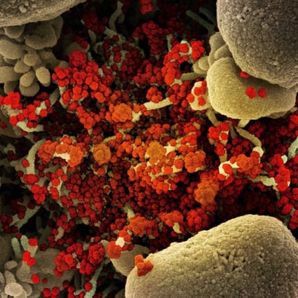 This colorized scanning electron micrograph of a cell heavily infected with SARS-CoV-2 virus particles (orange/red) was captured at the NIAID Integrated Research Facility (IRF) in 2020. Photo: NIAID via ZUMA Wire/TNS