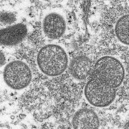 An electron microscopic (EM) image shows mature, oval-shaped monkeypox virus particles as well as crescents and spherical particles of immature virions. Image: CDC via Reuters