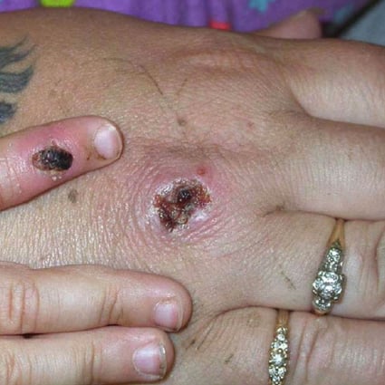 Symptoms of the monkeypox virus on a patient’s hand. File photo: TNS