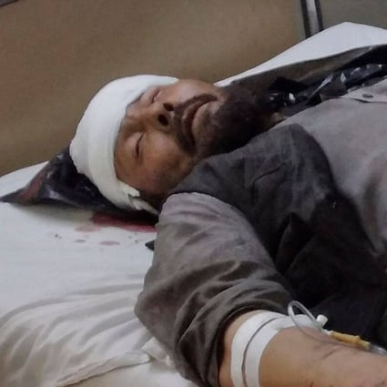 An injured bomb blast victim rests inside a hospital in Mazar-i-Sharif on Wednesday. Photo: AFP