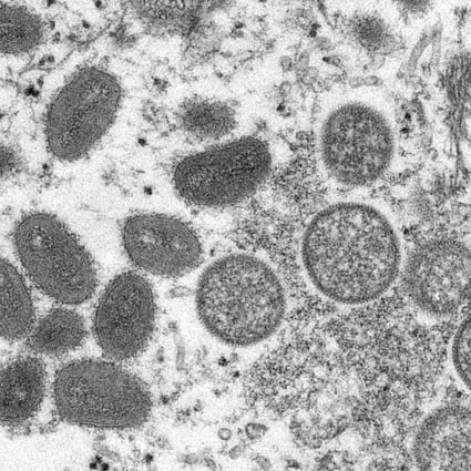 Monkeypox is related to smallpox, which killed millions around the world every year before it was eradicated in 1980. Photo: AP