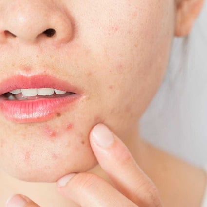 Skin purging is what happens when you start using a new facial care product with a previously unused ingredient. Although it can look like a breakout, it is actually quite different. Photo: Handout