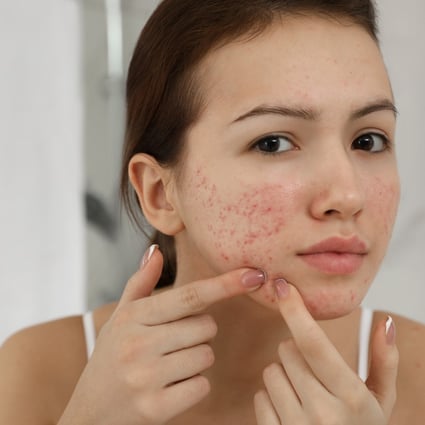 Simple skincare is the key to clearing up or preventing teenage acne, says a dermatology expert. Photo: Shutterstock