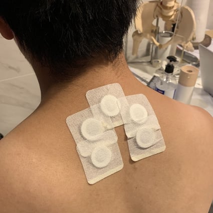 In the traditional Chinese medicine treatment of san fu moxibustion, plasters containing a warm herbal paste are applied to acupressure points, usually on the upper back. Photo: Samuel To