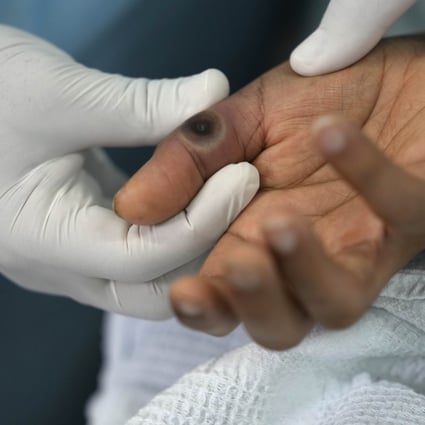A doctor shows a sore on a patient´s hand caused by monkeypox in Peru. Photo: AP