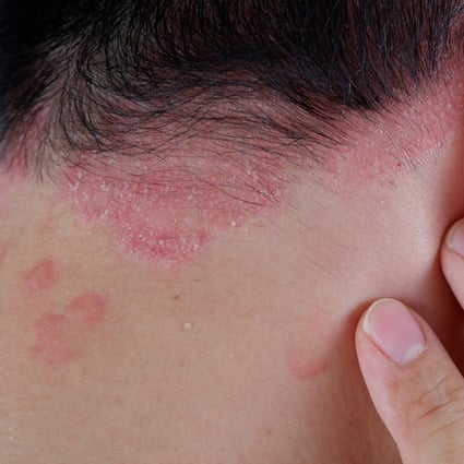 It can be difficult for the untrained eye to tell the difference between mild eczema and psoriasis (above). Photo: Shutterstock