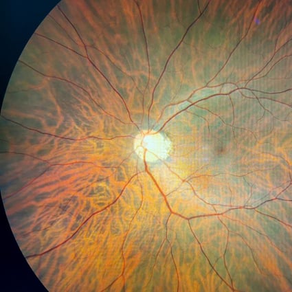 Hong Kong scientists have developed an artificial intelligence model that can screen for Alzheimer’s disease by reading a patient’s retina images. Photo: Shutterstock