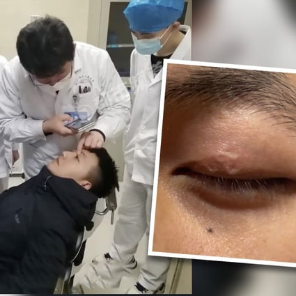 ‘Scary’ video of parasitic worms in man’s eyelid trends in China after