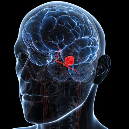 A brain aneurysm occurs when there is a bulge in a weak area of an artery in the brain. A ruptured aneurysm can also cause people to experience extremely painful headaches, nausea, vomiting, stiff neck, blurry vision or a serious loss of consciousness. Photo: Getty Images
