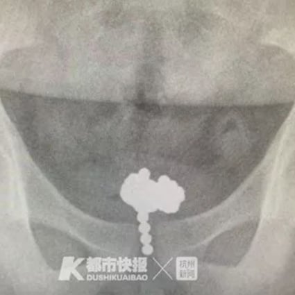The boy admitted inserting the balls when X-rays showed a shadow in his bladder. Photo: Guancha