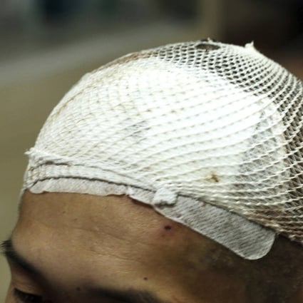 A white mesh covers the head of Yan after he had a deep brain stimulation device implanted as part of a clinical trial at Ruijin Hospital in Shanghai. Photo: AP