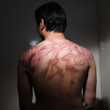 Calvin So shows the marks on his back caused by a brutal attack near Yuen Long MTR station on Sunday night. Photo: Sam Tsang