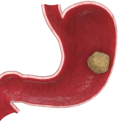 What Is The First Sign Of Stomach Cancer : Targeted And Novel Therapy In Advanced Gastric Cancer Experimental Hematology Oncology Full Text / Stomach cancer begins when cancer cells form in the inner lining of your stomach.these cells can grow into a tumor.