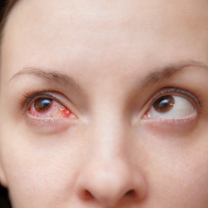 You can infect yourself with adenoviruses by touching infected surfaces and then rubbing your eyes.