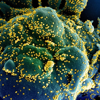 An electron micrograph shows a cell infected with coronavirus particles. A new study has found blood thinners could benefit the most severely ill patients. Photo: EPA-EFE