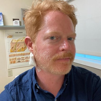 Jesse Tyler Ferguson got ‘a bit of skin cancer’ removed during a visit to a dermatologist and went on Instagram to warn others to put on high-SPF sunscreen.