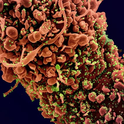 An image from a scanning electron microscope shows coronavirus particles in green on an infected human cell. Photo: EPA-EFE