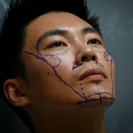 Scientific researcher Xia Shurong is shown with markings on his face before having plastic surgery at a clinic in Beijing. Worried his appearance would detract from opportunities in China's competitive society, Xia Shurong decided to go under the surgeon's knife to reshape his nose. Photo: AFP