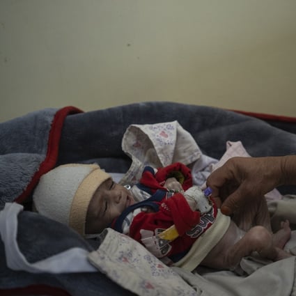 Four-month-old Mohammed who is malnourished lays on a hospital bed in the Indira Gandhi hospital in Kabul on Nov 8, 2021. Photo: AP