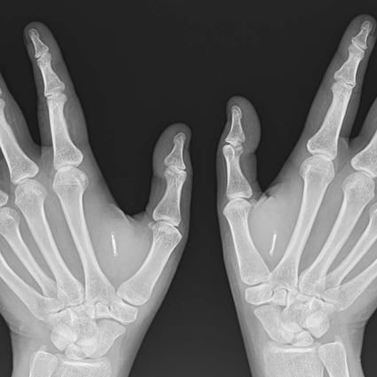 Shanti Korporaal’s implants can clearly be seen in this X-ray between thumb and forefinger on each hand.