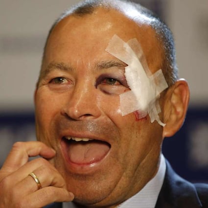 England coach Eddie Jones is all smiles during the Six Nations launch despite a bruised face. Photos: Reuters